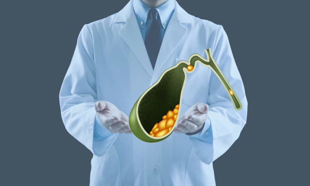 Một số biểu hiện của bệnh sỏi mật khiến bệnh nhân nhầm là bệnh dạ dày   