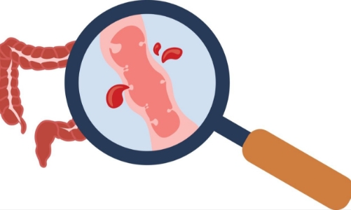 Nhiều người trẻ ở Việt Nam chủ quan với bệnh lý xuất huyết tiêu hóa