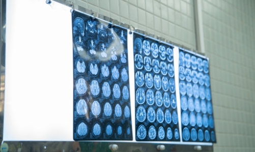 Moyamoya: Hội chứng nguy hiểm ít được biết đến