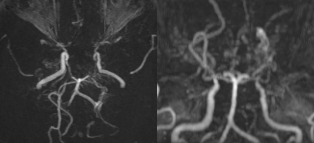 Các mạch máu não của bệnh nhân nhìn như “làn khói thuốc lá” trên phim chụp MRI.