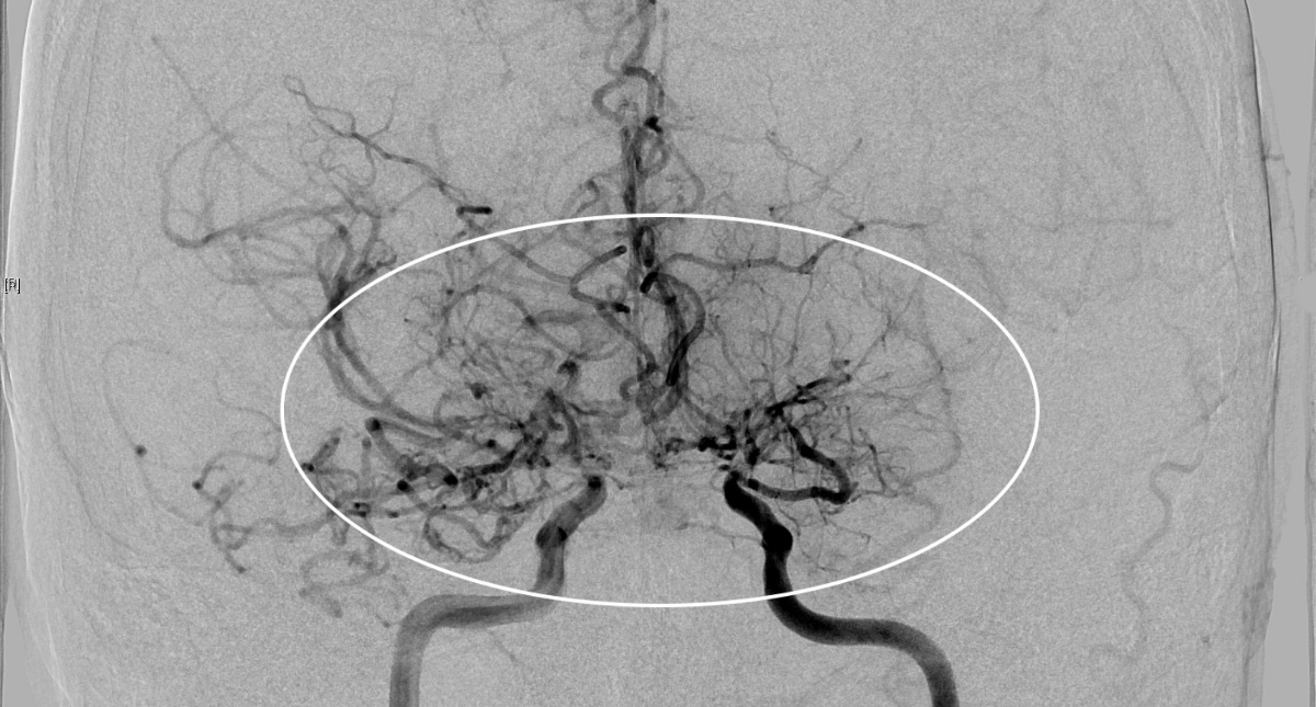 Moyamoya trong tiếng Nhật Bản là “làn khói thuốc lá”, mô tả tuần hoàn bàng hệ là mạch máu nhỏ bất thường.