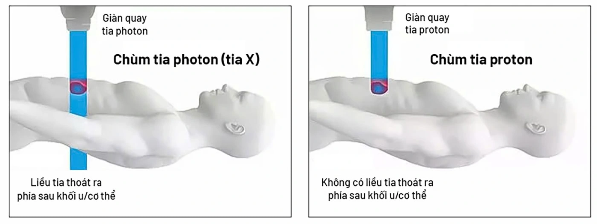 Xạ trị photon (tia X) có thể 
