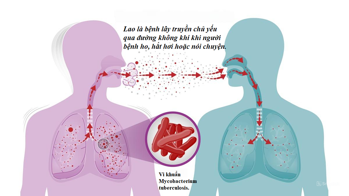Tình hình dịch tễ bệnh lao&nbsp;tại&nbsp;Việt Nam còn rất nặng nề.