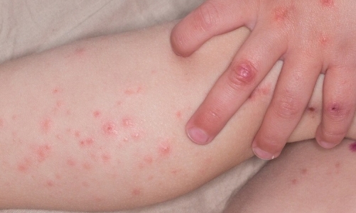 Số ca mắc bệnh tay chân miệng tăng mạnh, Bộ Y tế ra chỉ đạo khẩn