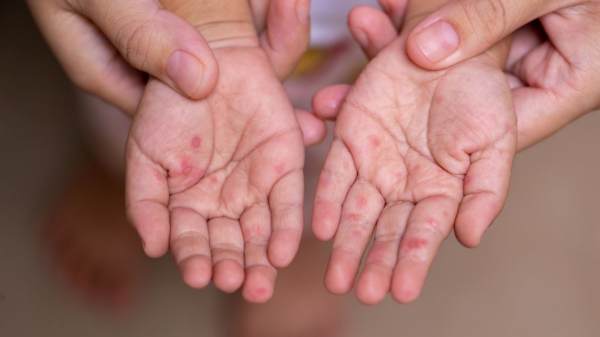 80% ca bệnh tay chân miệng chủng EV71 thuộc nhóm trẻ em dưới 5 tuổi