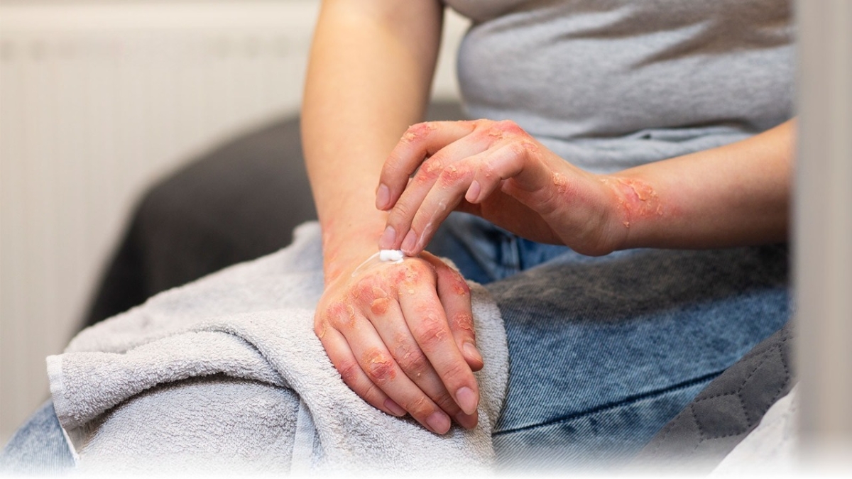 Người mắc từ ba bệnh tự miễn trở lên được gọi là hội chứng đa tự miễn (MAS).