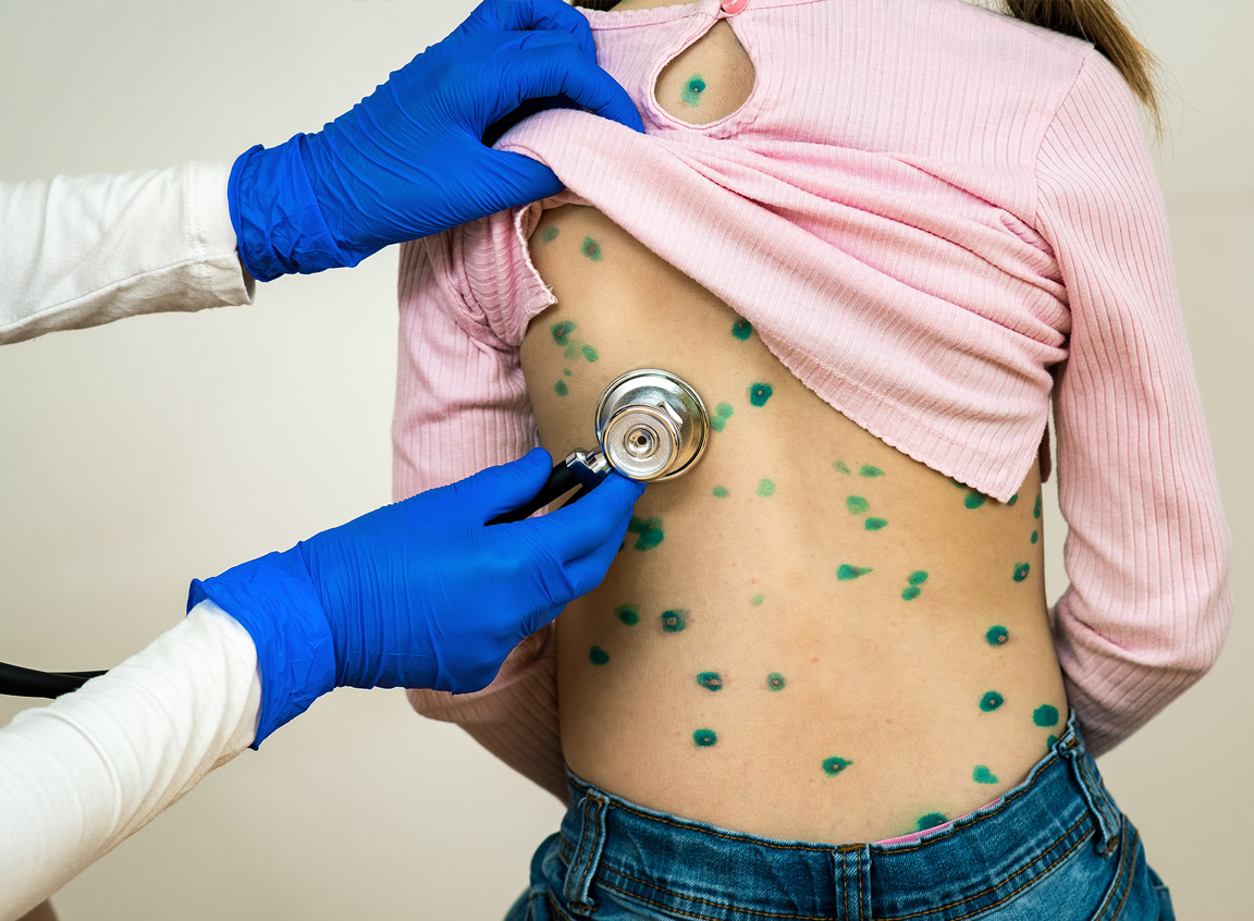 Người dân không được lơ là với các dấu hiệu ban đầu như sốt, mệt mỏi hay nổi mụn nước.