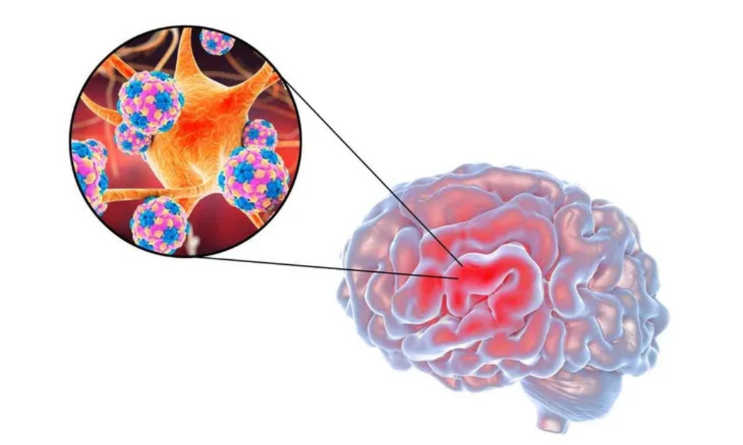 Đã có 4 ca bệnh do não mô cầu tử vong, Bộ Y tế ra khuyến cáo