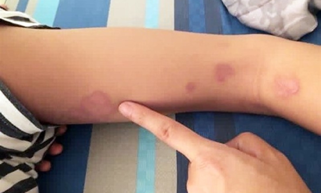 Căn bệnh khiến Thái Lan cảnh báo khẩn, Bộ Y tế ra khuyến cáo