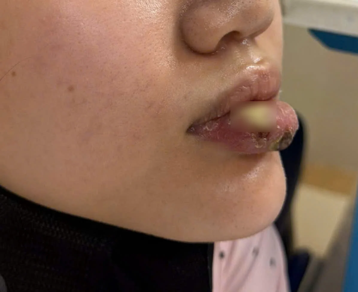 Hình ảnh môi bị nhiễm trùng sau khi sau tiêm “giải filler” tại cơ sở không phép.
