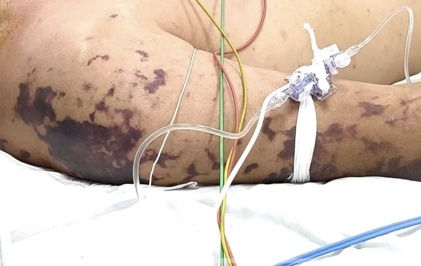 Não mô cầu là bệnh truyền nhiễm nguy hiểm do vi khuẩn Neisseria meningitidis gây ra.