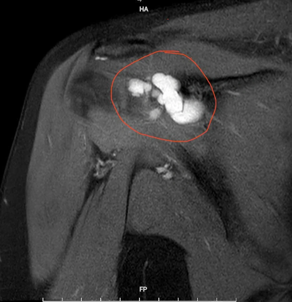Hình ảnh chụp cộng hưởng từ (MRI) khối u kích thước khoảng&nbsp;4×2&nbsp;cm gây hẹp khoang mỏm cùng vai, chèn ép các cấu trúc xung quanh.