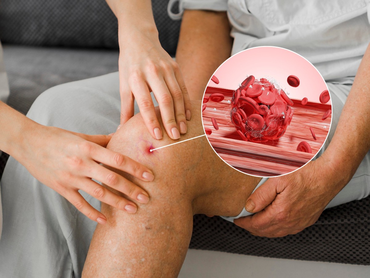 Sưng đau một bên chân cũng là một gợi ý cho tình trạng huyết khối tĩnh mạch sâu.