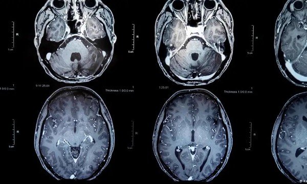 Thử nghiệm vaccine điều trị u não, mở ra hy vọng kéo dài sự sống cho bệnh nhân