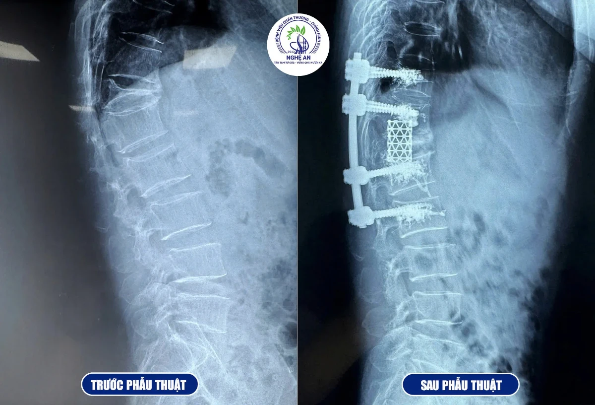 Hình ảnh đốt sống của bệnh nhân P.N.K. trước và sau phẫu thuật. Ảnh: Bệnh viện Chấn thương Chỉnh hình Nghệ An