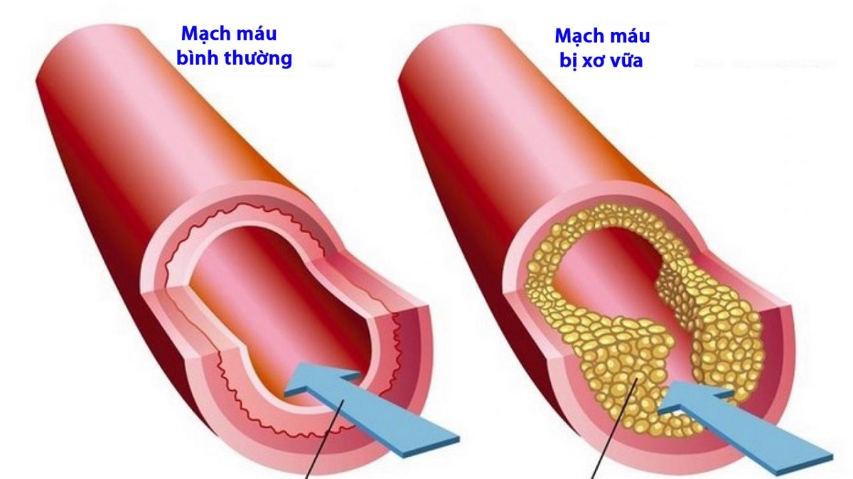 Nếu mảng xơ vữa nằm ở động mạch vành, người bệnh thường cảm thấy đau tức ngực. Ảnh: Bệnh viện đa khoa Quốc tế Thu Cúc