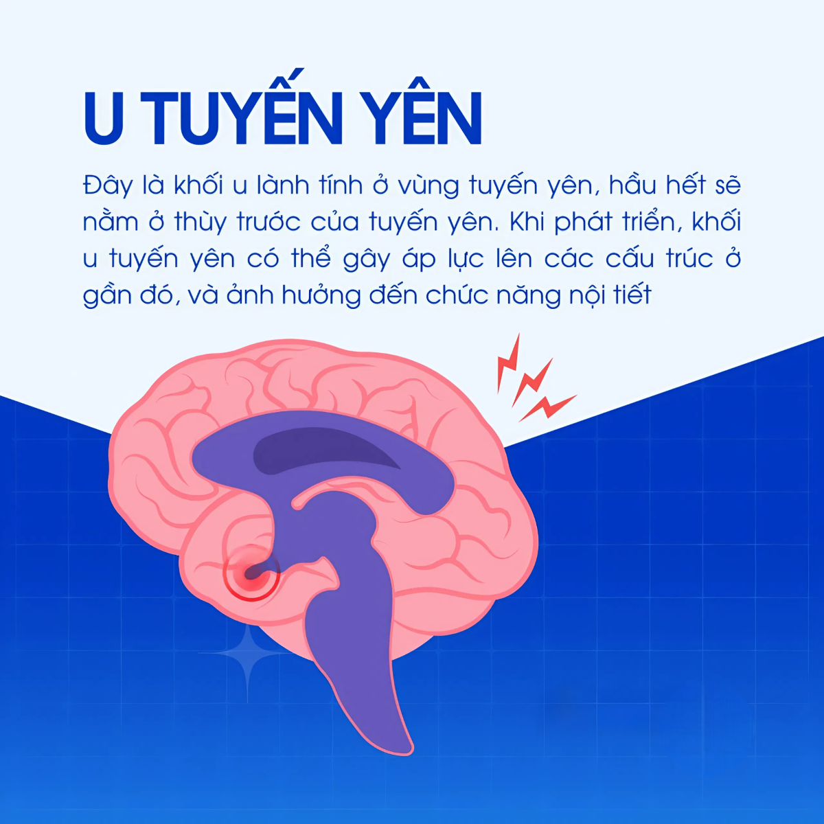 U tuyến yên có hai loại chính là u không tăng tiết hormone và u tăng tiết hormone, đa phần lành tính. Ảnh: Long Châu
