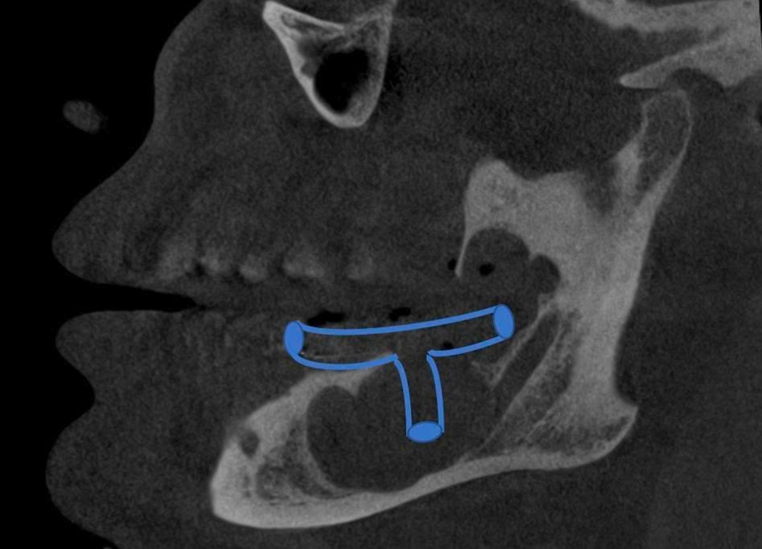A decompression tube is placed in the cyst cavity after surgery to reduce pressure and facilitate bone regeneration. Photo: FV Hospital